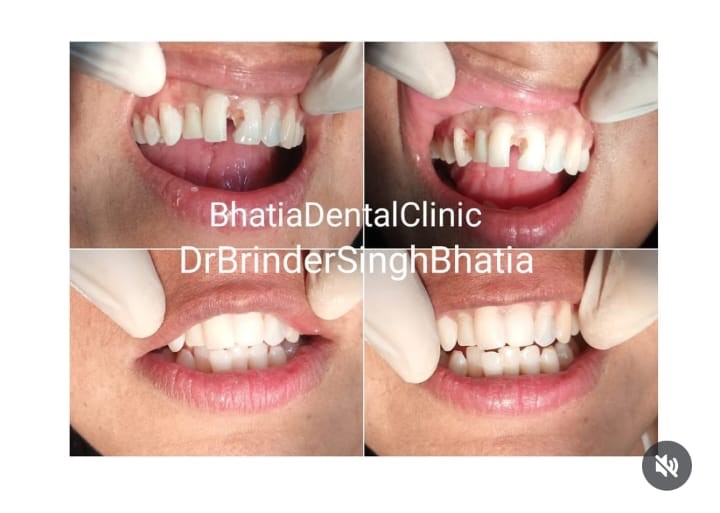 Tooth Alignment 1