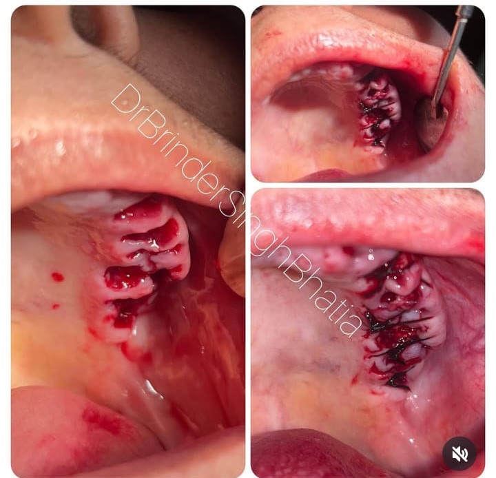 Tooth Alignment 2