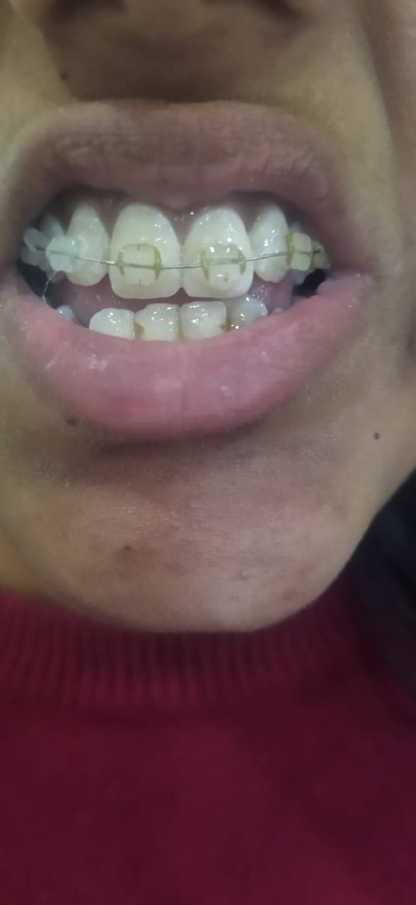Artificial Teeth 1