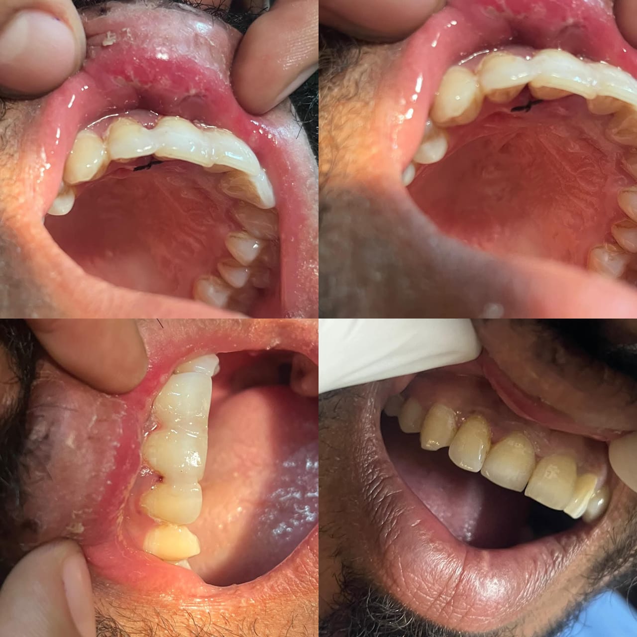 Artificial Teeth 2