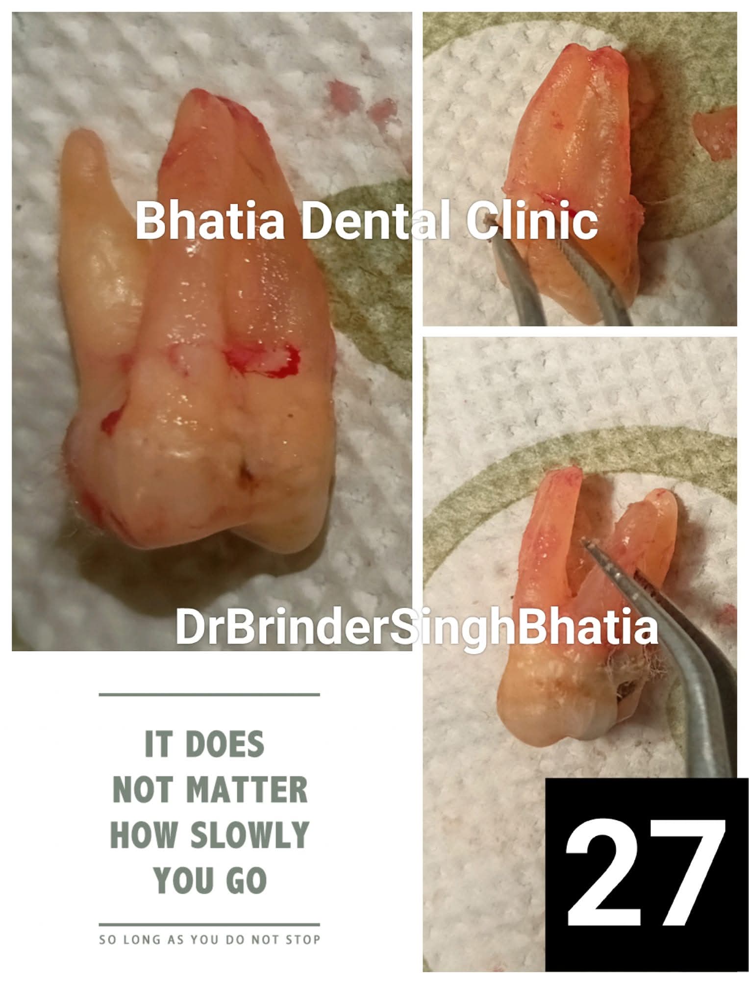 Artificial Teeth 3