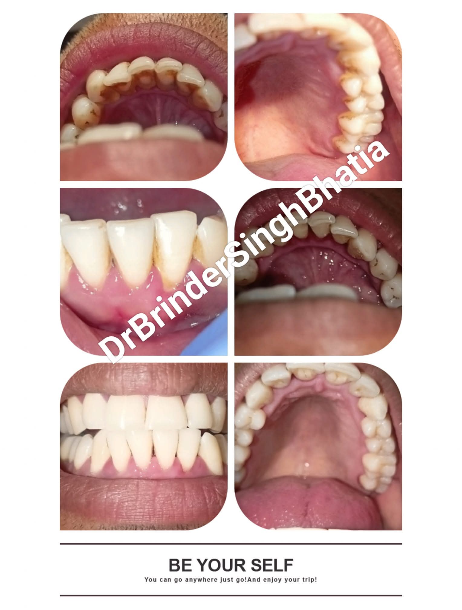 Artificial Teeth 4