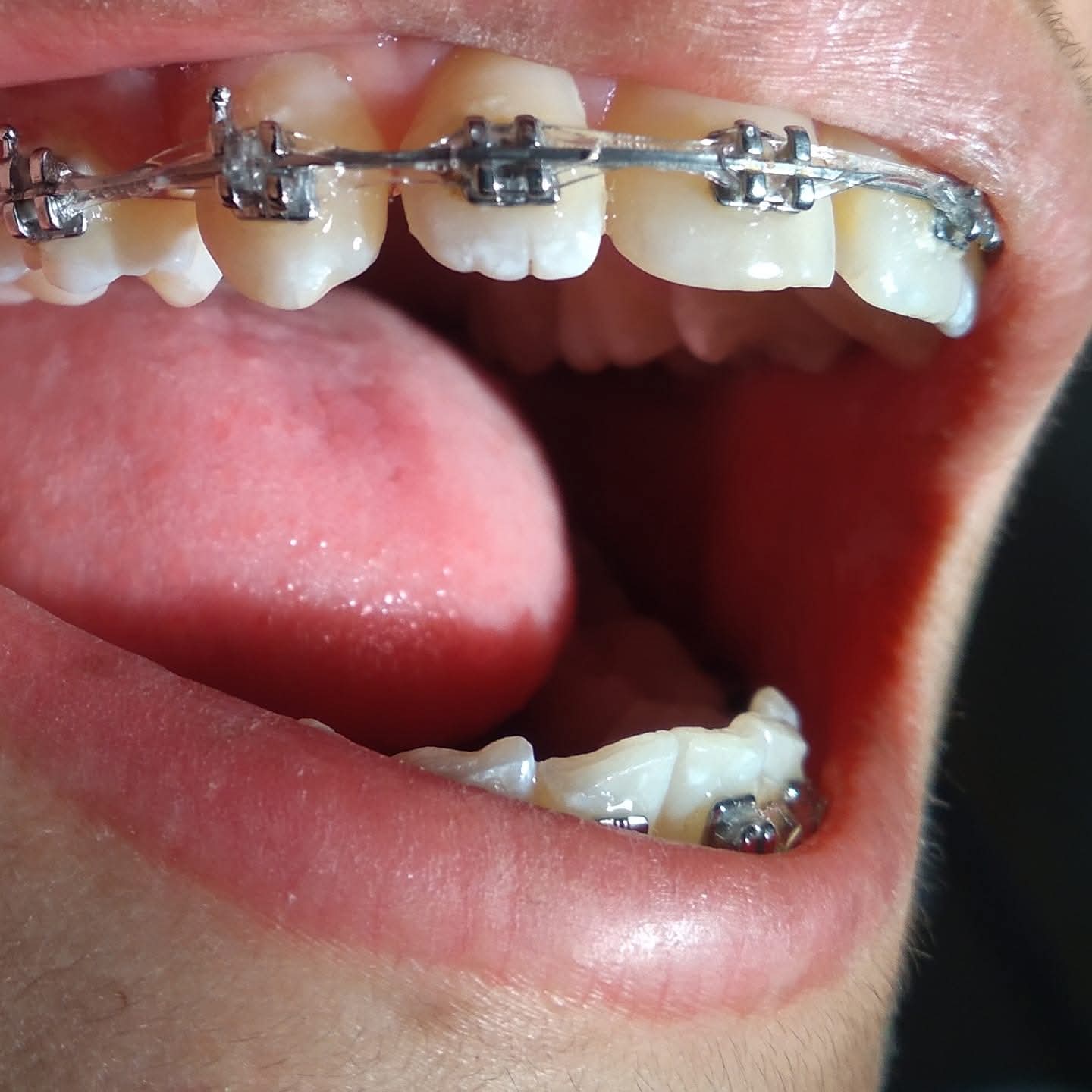 Artificial Teeth 6