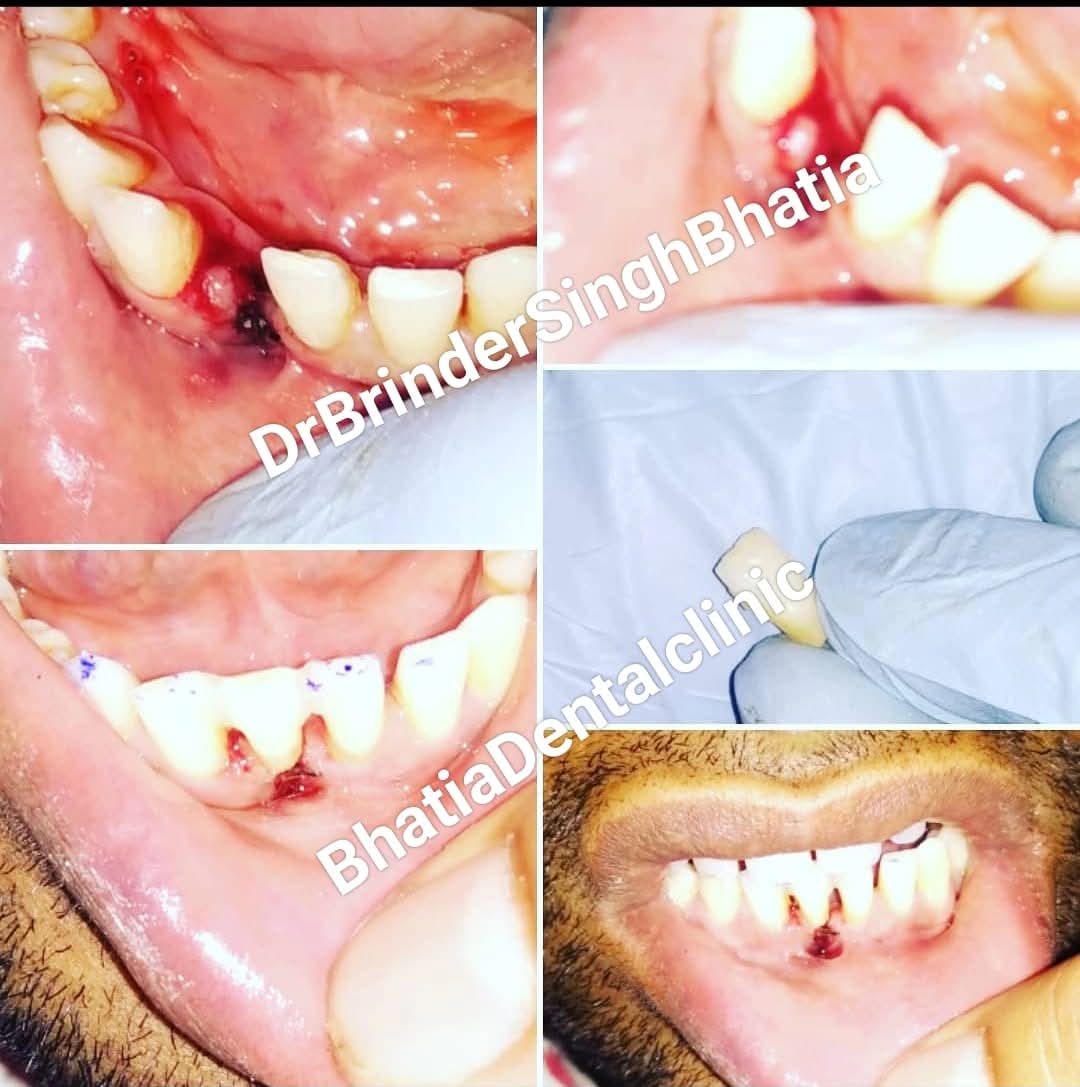 Artificial Teeth 6