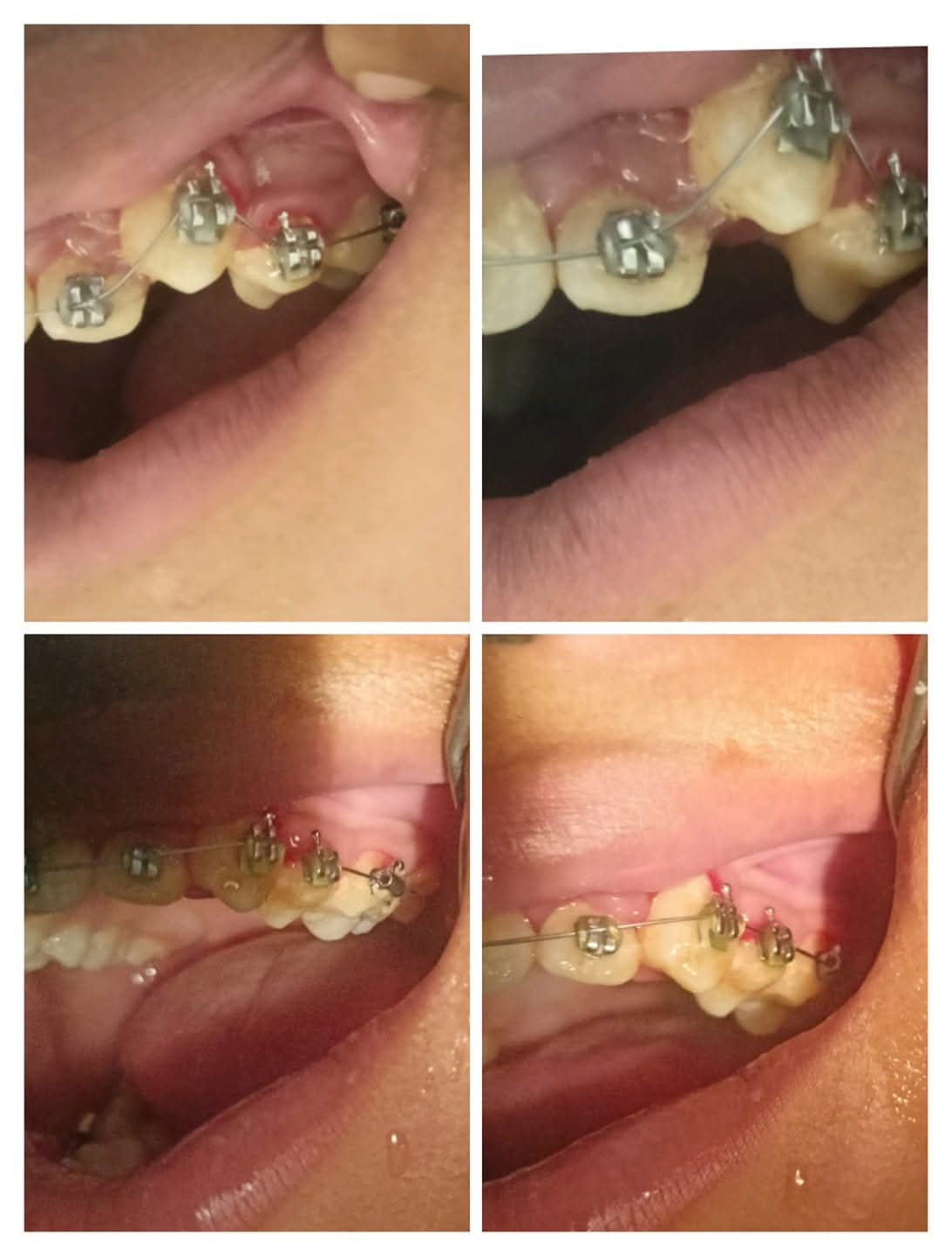 Artificial Teeth 6