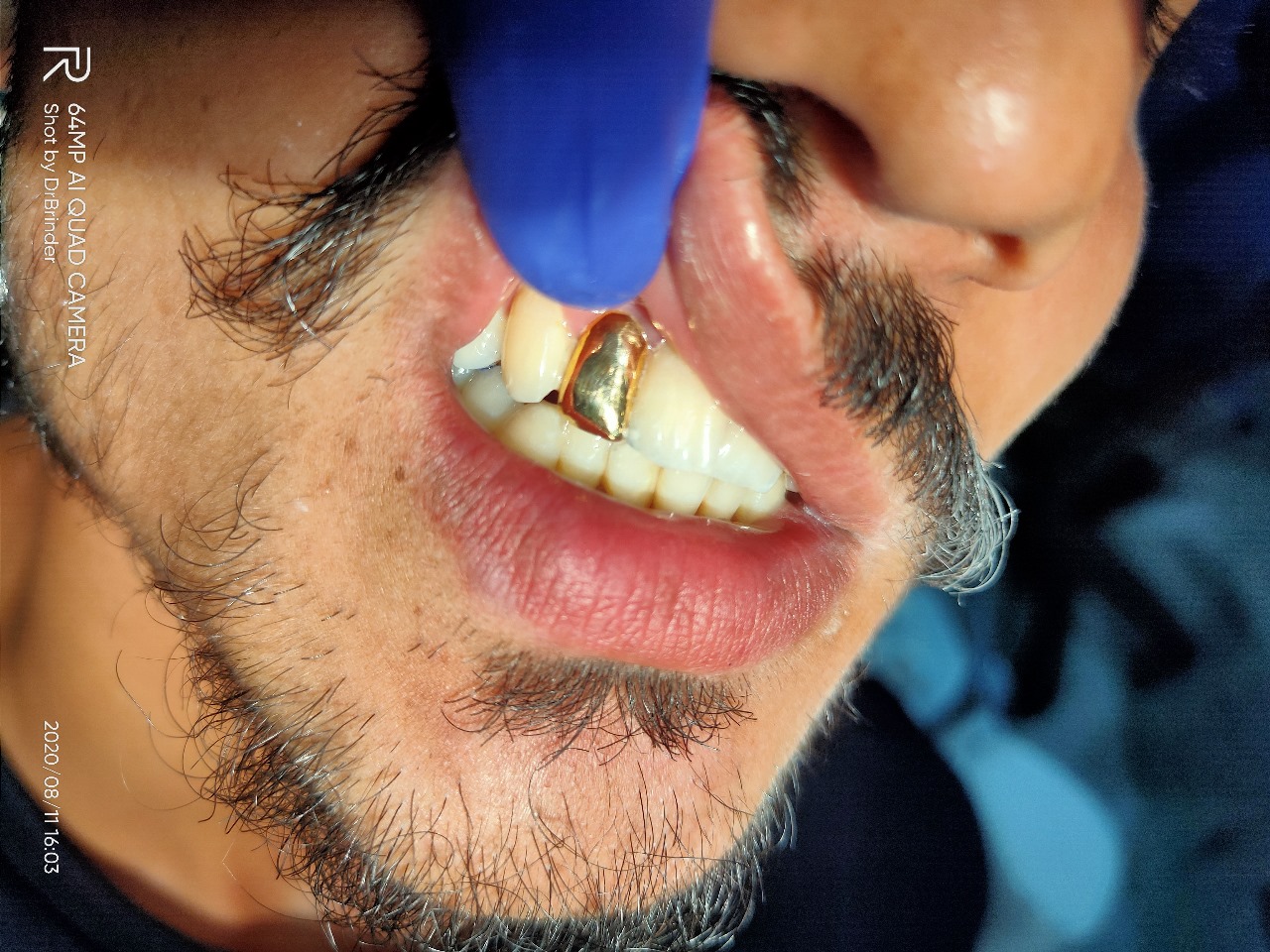 Dental Implant 2
